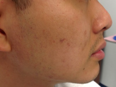 Before and After Picture