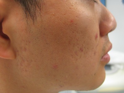 Before and After Picture