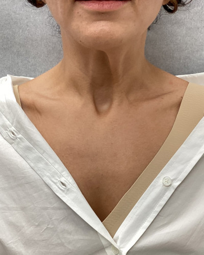 Before and After Picture