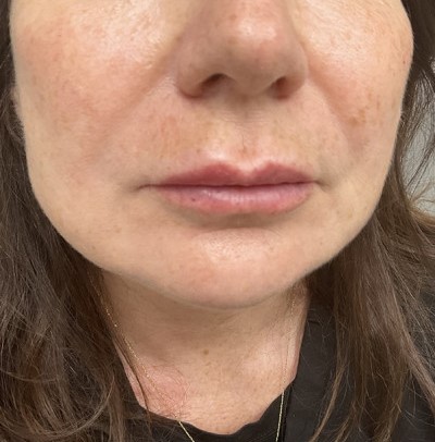 Before and After Picture