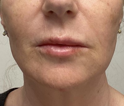 Before and After Picture