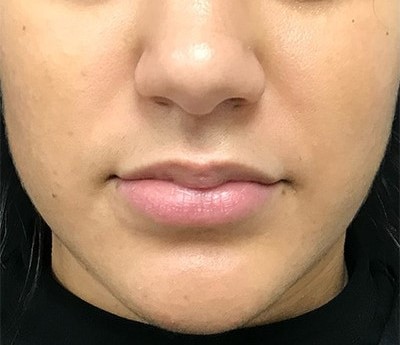 Before and After Picture