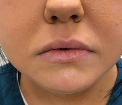 Before and After Picture