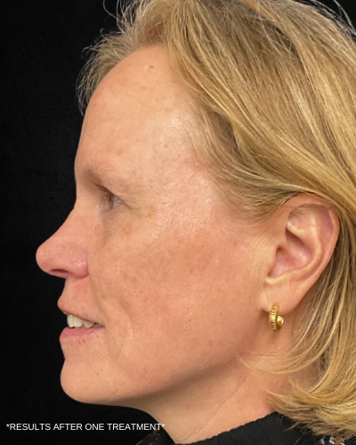 Before and After Picture