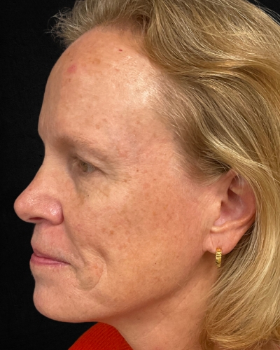 Before and After Picture