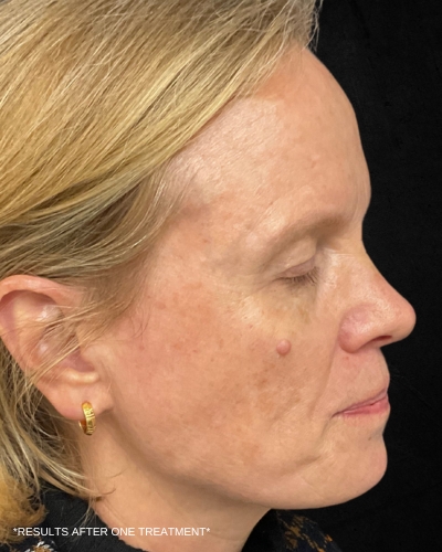 Before and After Picture