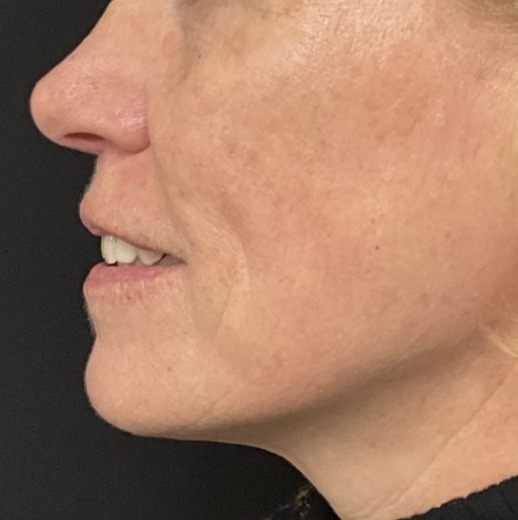 Before and After Picture