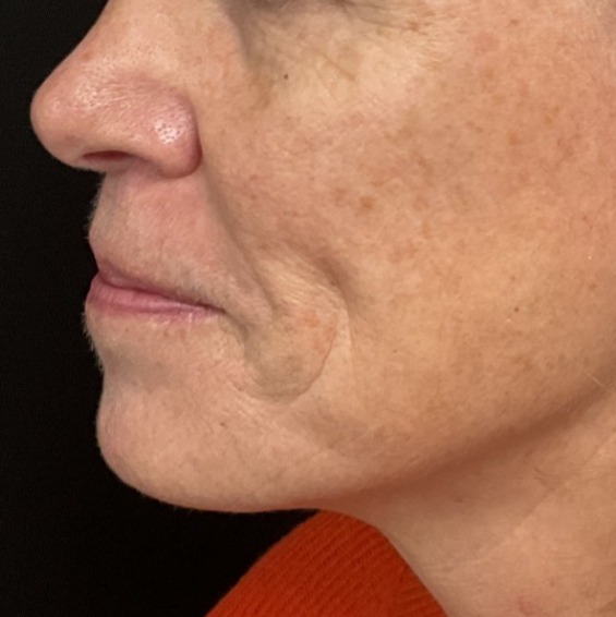 Before and After Picture