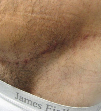 Before and After Picture