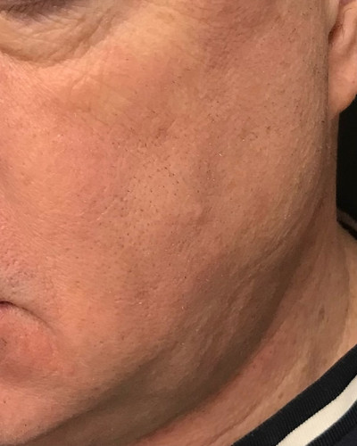 Before and After Picture