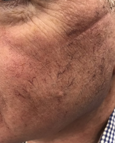 Before and After Picture