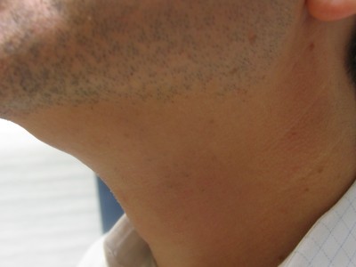 Before and After Picture