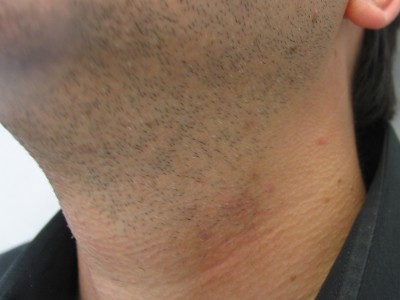 Before and After Picture