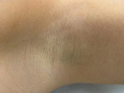 Before and After Picture