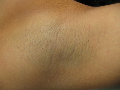 Before and After Picture