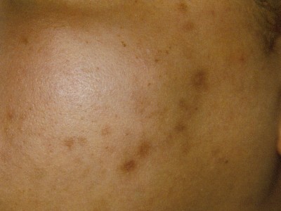 Before and After Picture