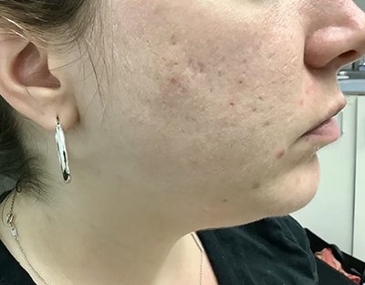 Before and After Picture