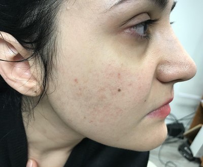 Before and After Picture