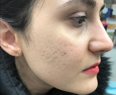 Before and After Picture