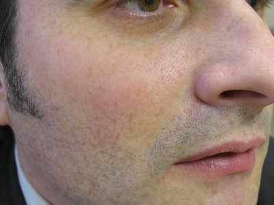 Before and After Picture