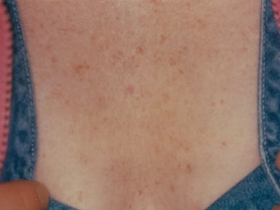 Before and After Picture