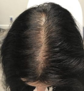 PRP Injections for Hair Loss