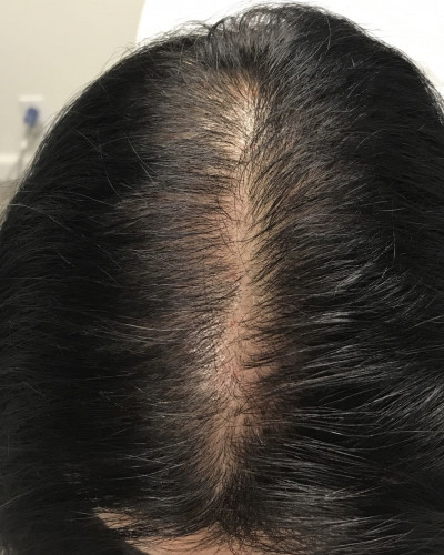 Before and After Picture