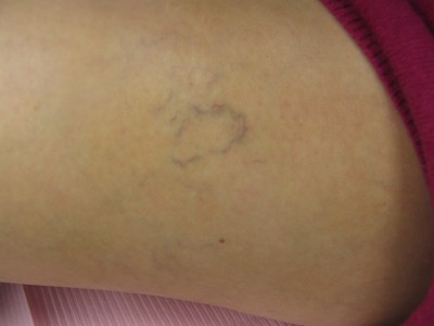 Before and After Picture