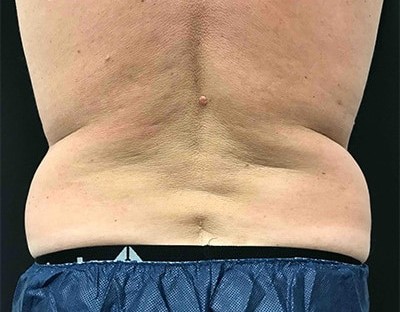 Before and After Picture