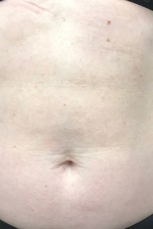 Before and After Picture