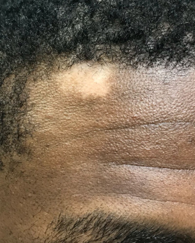 Before and After Picture